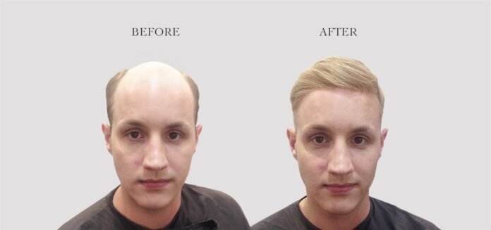 Hair Loss Solutions For Men Hair Loss Solutions
