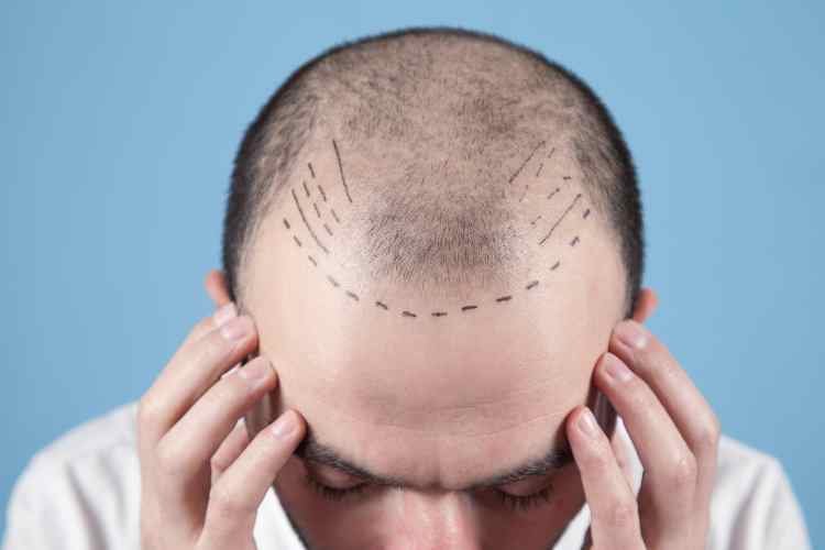 Price of a Hair Transplant Procedure: Factors That Get to Decide